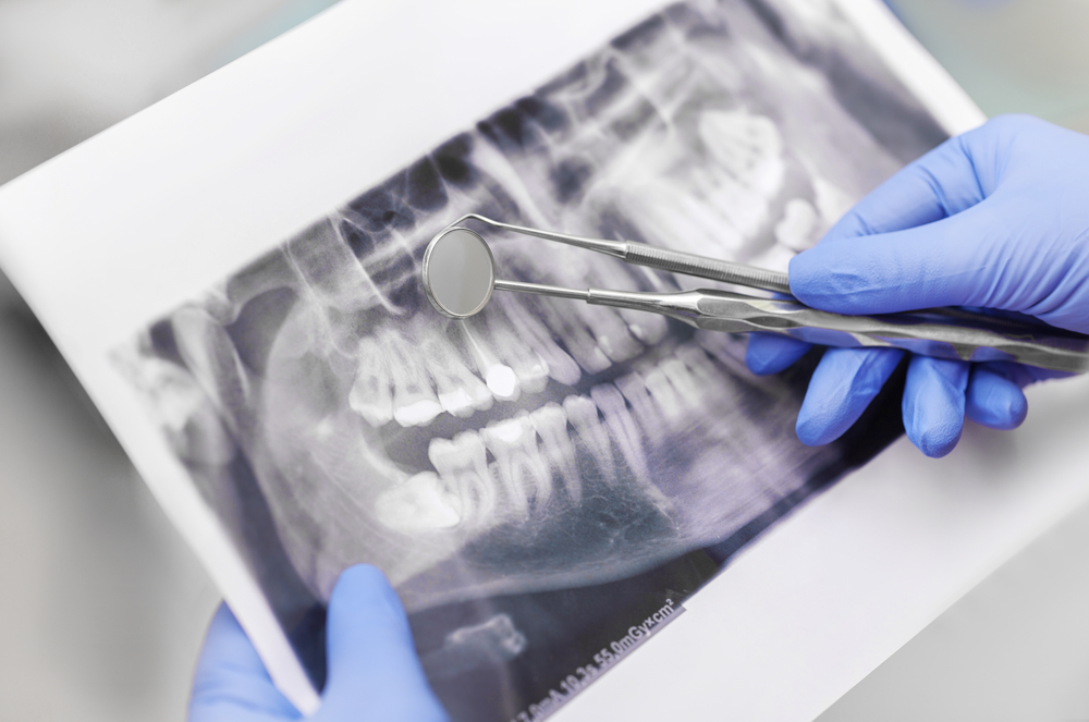 precise dental checkups with digital X-Rays
